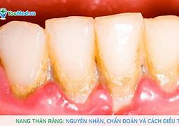 Nang Chân Răng Sinh Sừng Là Gì